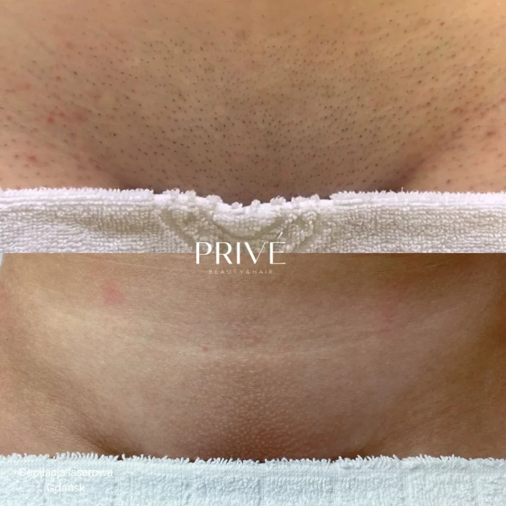 Depilacja laserowa bikini w PRIVE Gdańsk - porównanie efektów przed i po