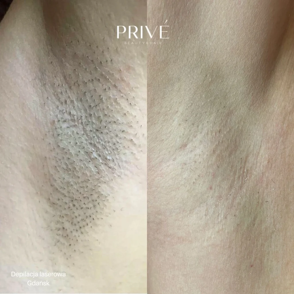 Depilacja laserowa pach w PRIVE Beauty & Hair Gdańsk - efekt przed i po