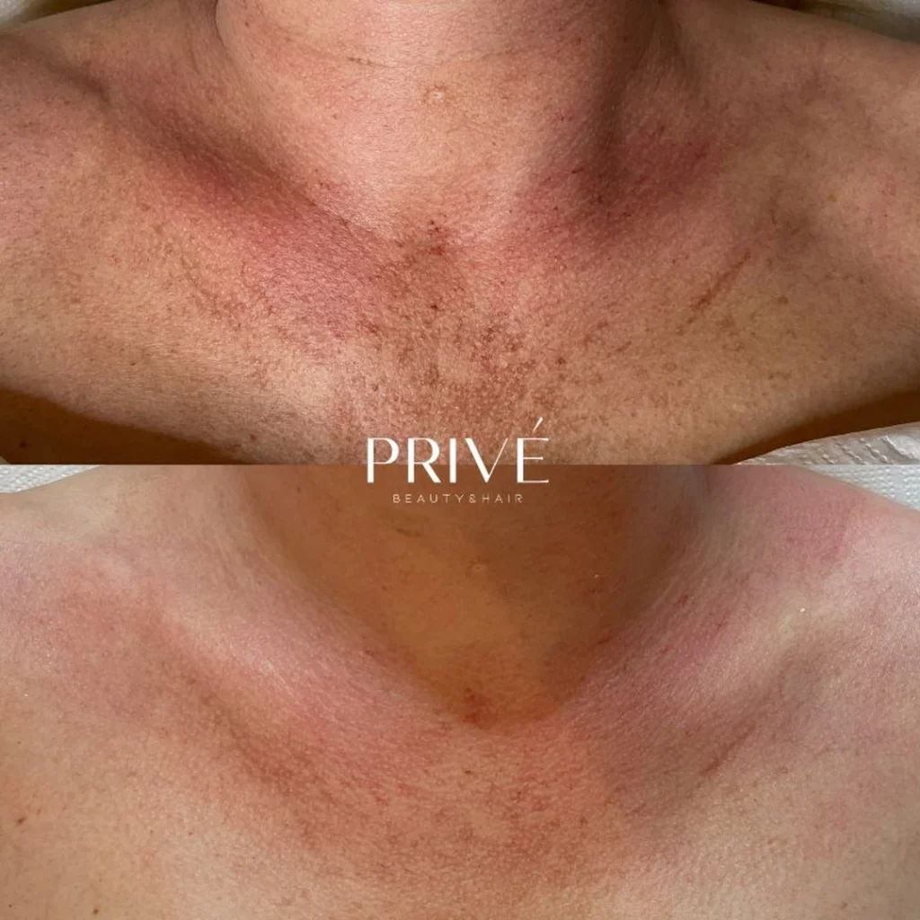 AzelaicPeel – trądzik różowaty na dekolcie przed i po w PRIVE Gdańsk