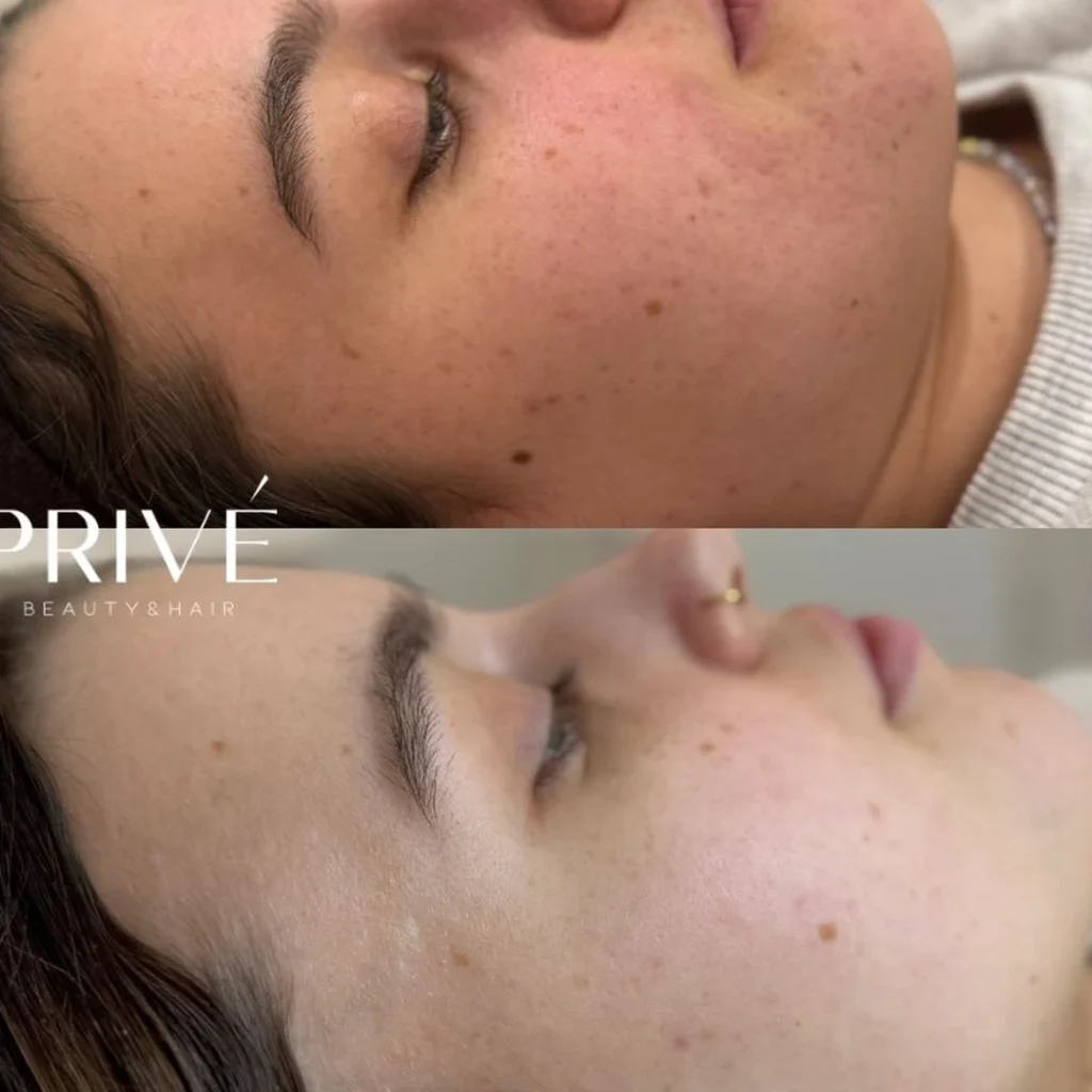 AzelaicPeel – poprawa cery policzka przed i po w PRIVE Gdańsk
