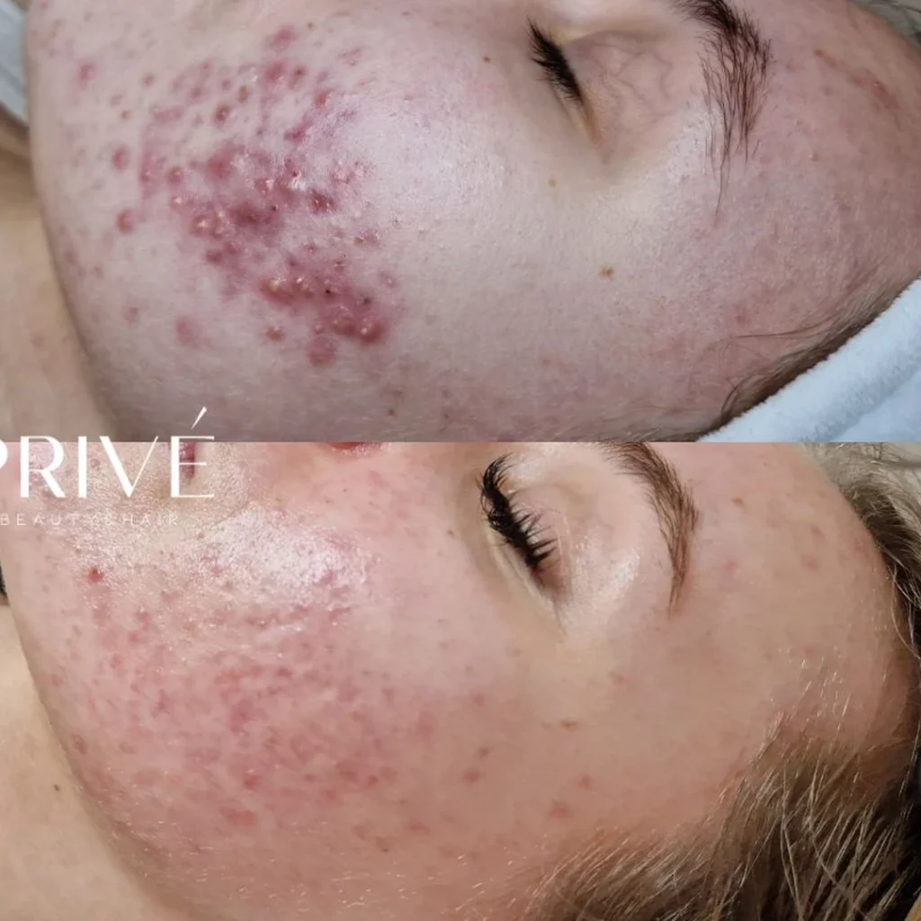 AzelaicPeel – trądzik różowaty przed i po zabiegu w PRIVE Gdańsk