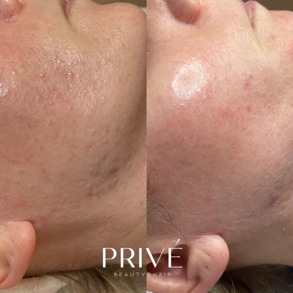 Peeling Hibiscus Mandelic – poprawa kondycji cery przed i po w PRIVE Gdańsk