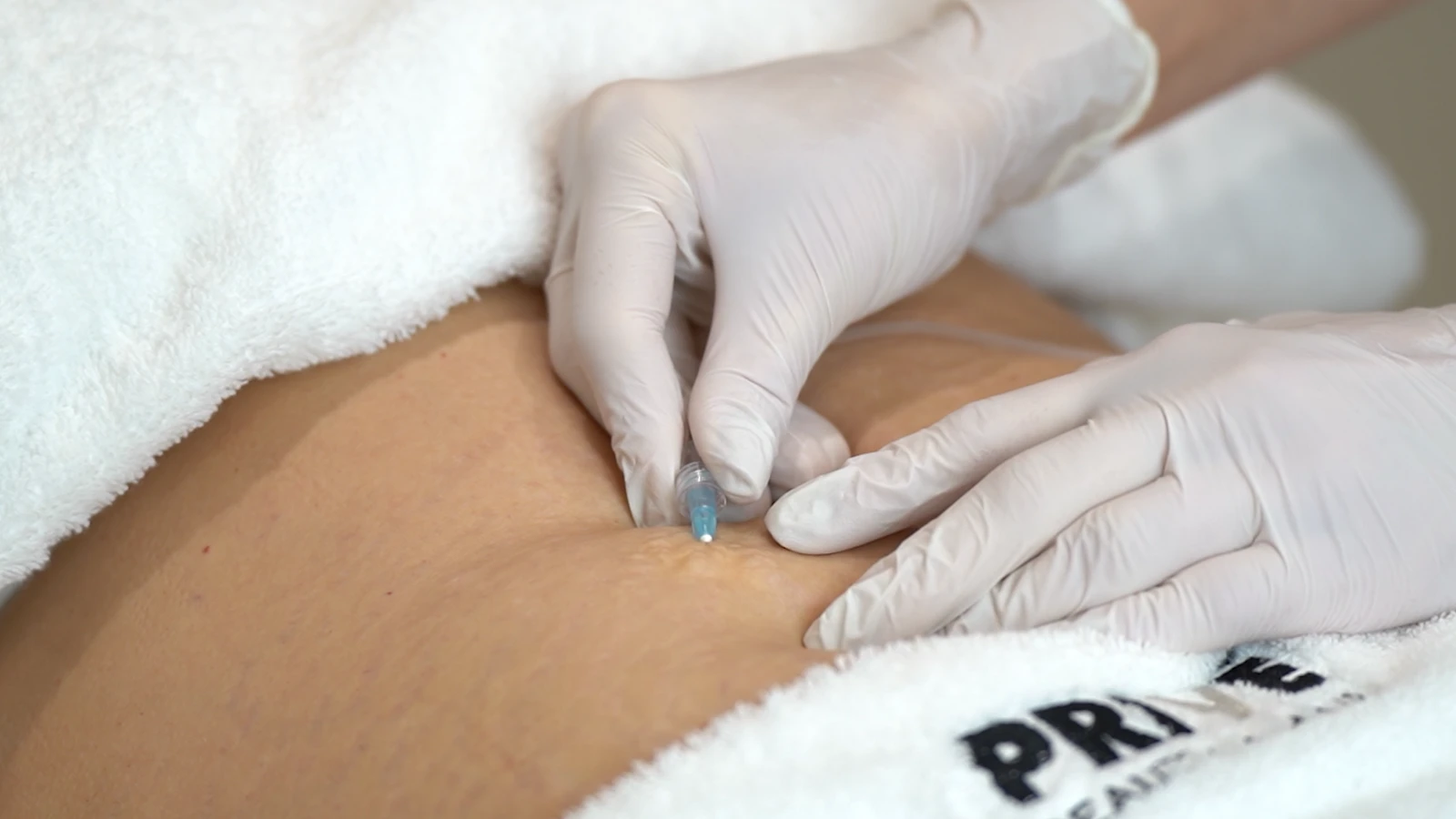 Karboksyterapia brzucha – podanie CO2 pod skórę w PRIVE Beauty & Hair Gdańsk