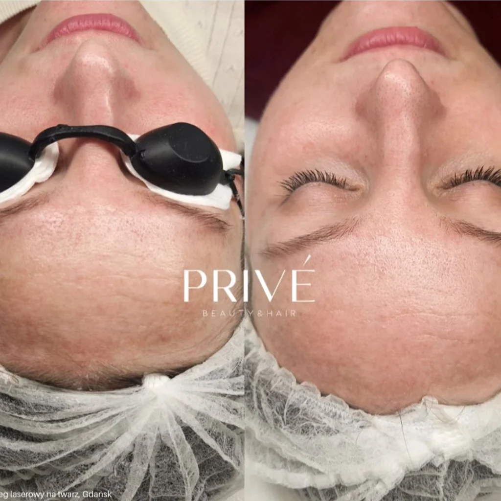 MangoLift Collagen Therapy – wyrównanie kolorytu przed i po w PRIVE Gdańsk