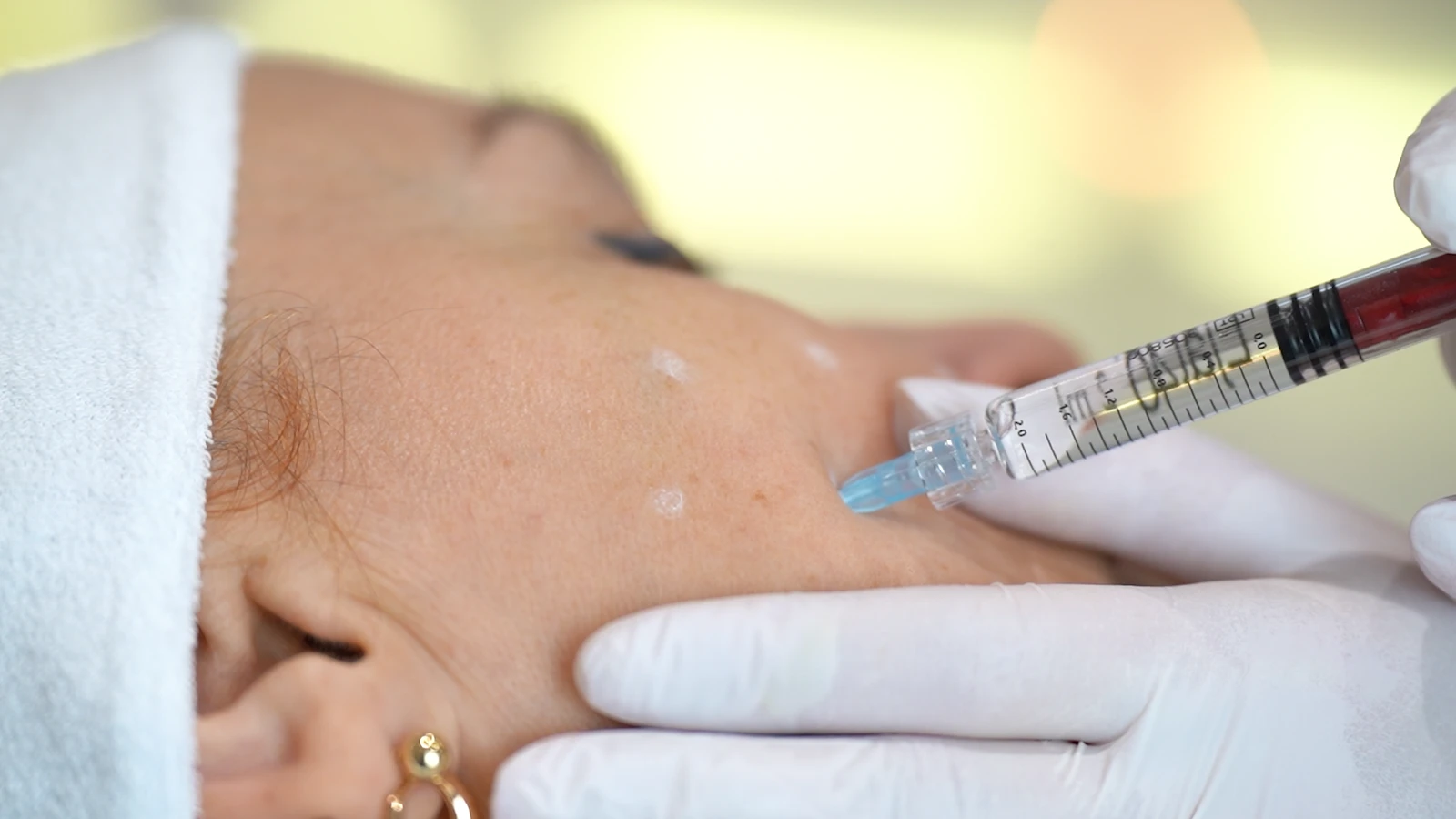 Mikroiniekcje preparatu w skórę podczas mezoterapii igłowej w PRIVE Gdańsk