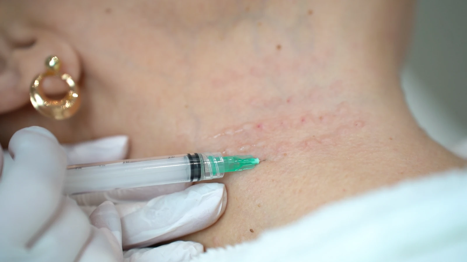 Mezoterapia igłowa – iniekcja preparatu w skórę w PRIVE Beauty & Hair Gdańsk