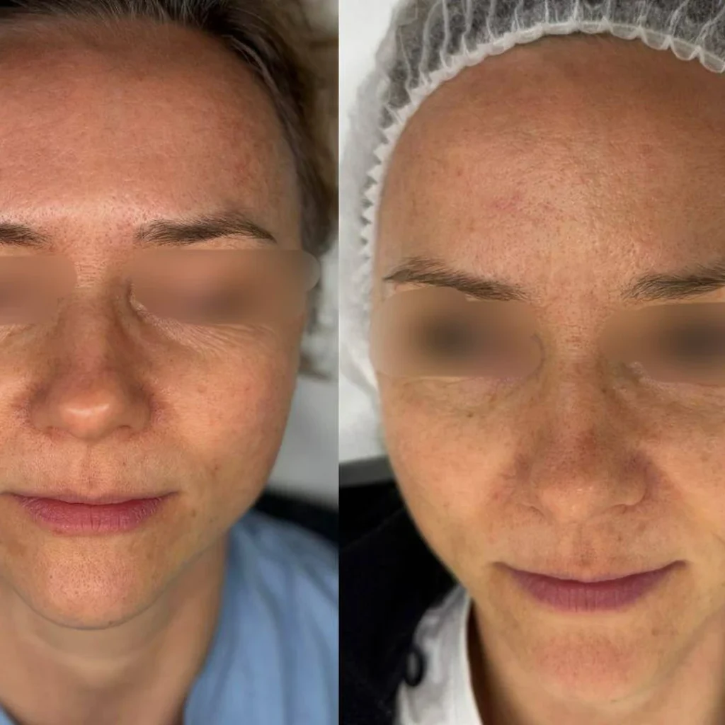 Mezoterapia z Vital Injector twarzy – nawilżenie skóry przed i po w PRIVE Gdańsk