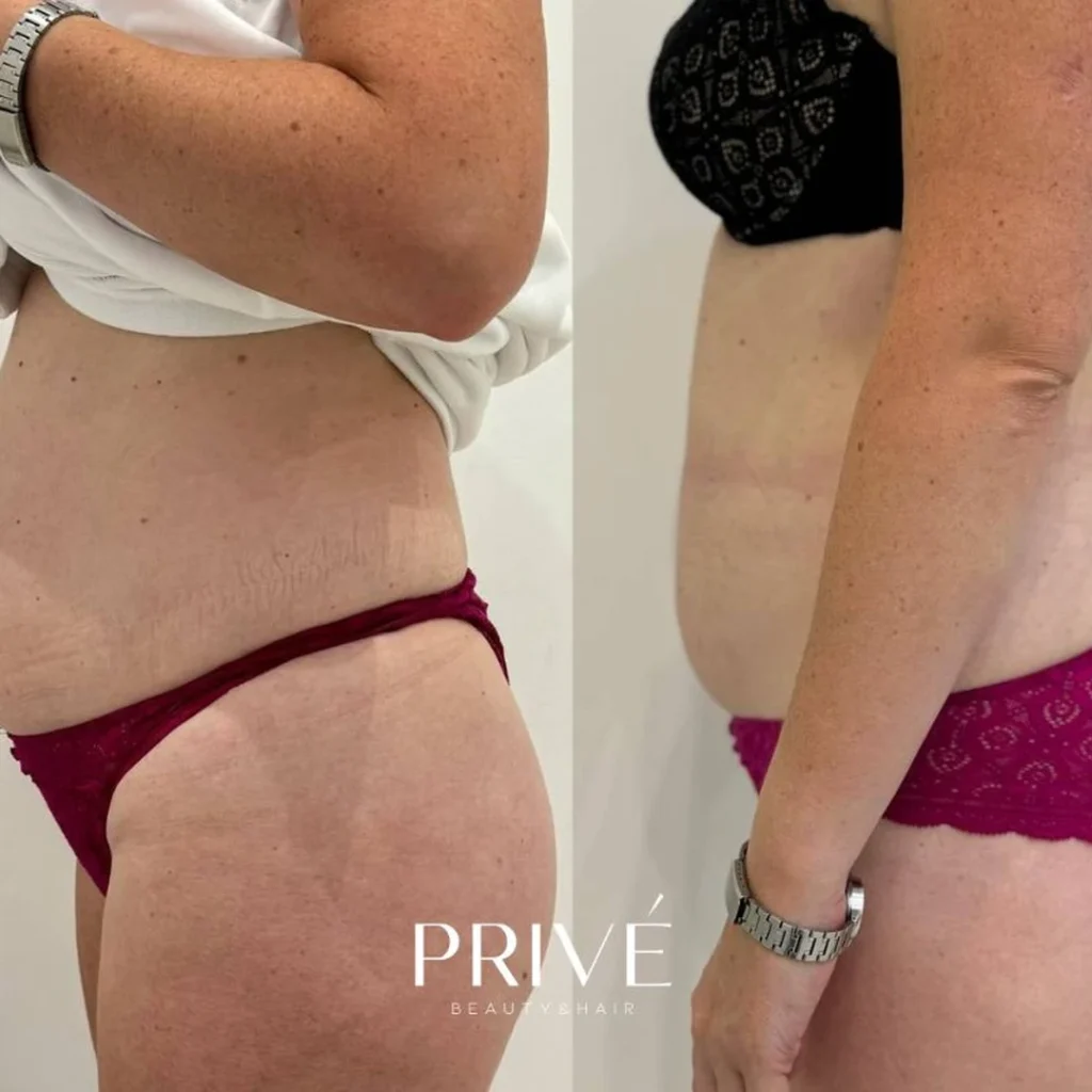 Modelowanie sylwetki – redukcja cellulitu ud przed i po w PRIVE Beauty & Hair Gdańsk