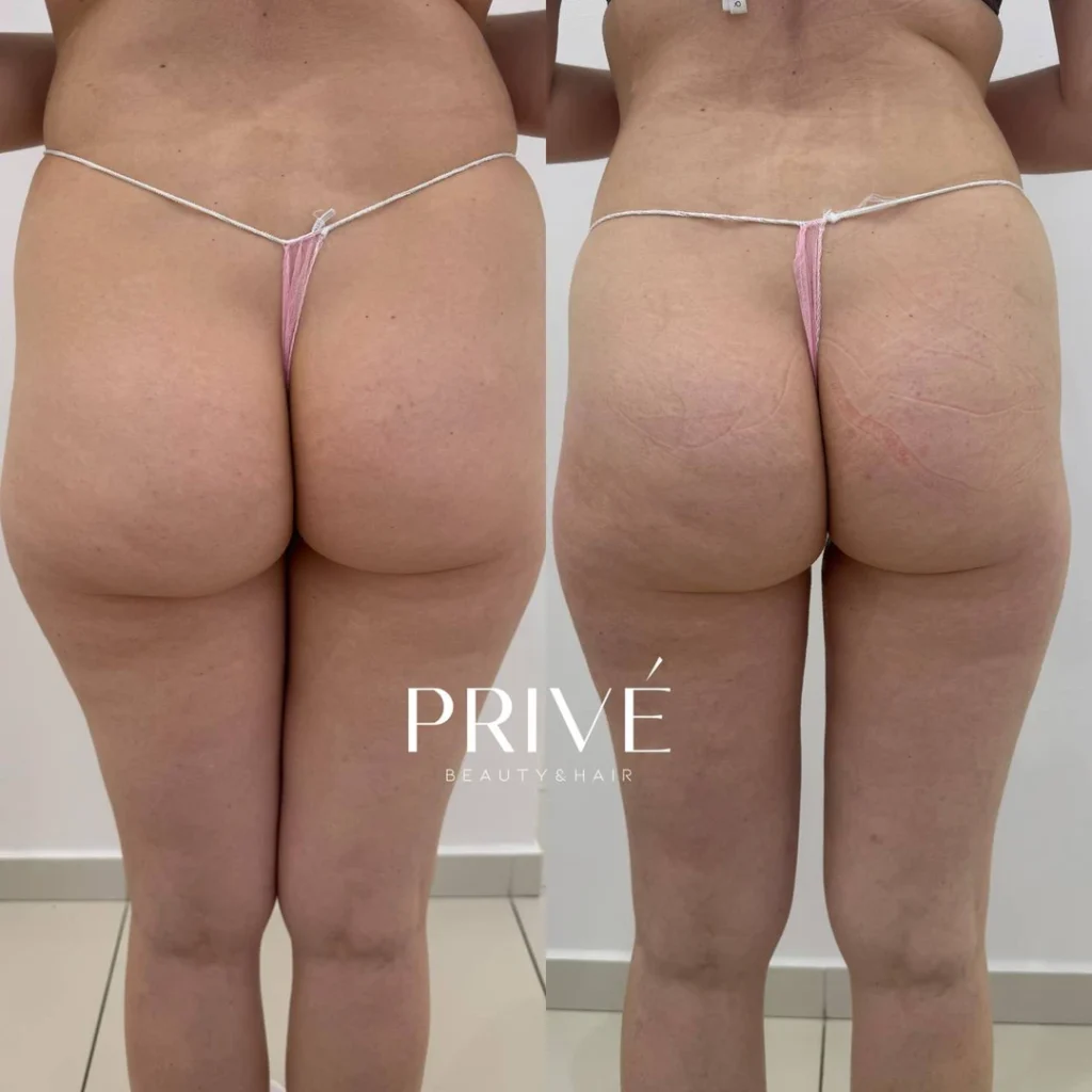 Modelowanie sylwetki – redukcja cellulitu ud przed i po w PRIVE Beauty & Hair Gdańsk