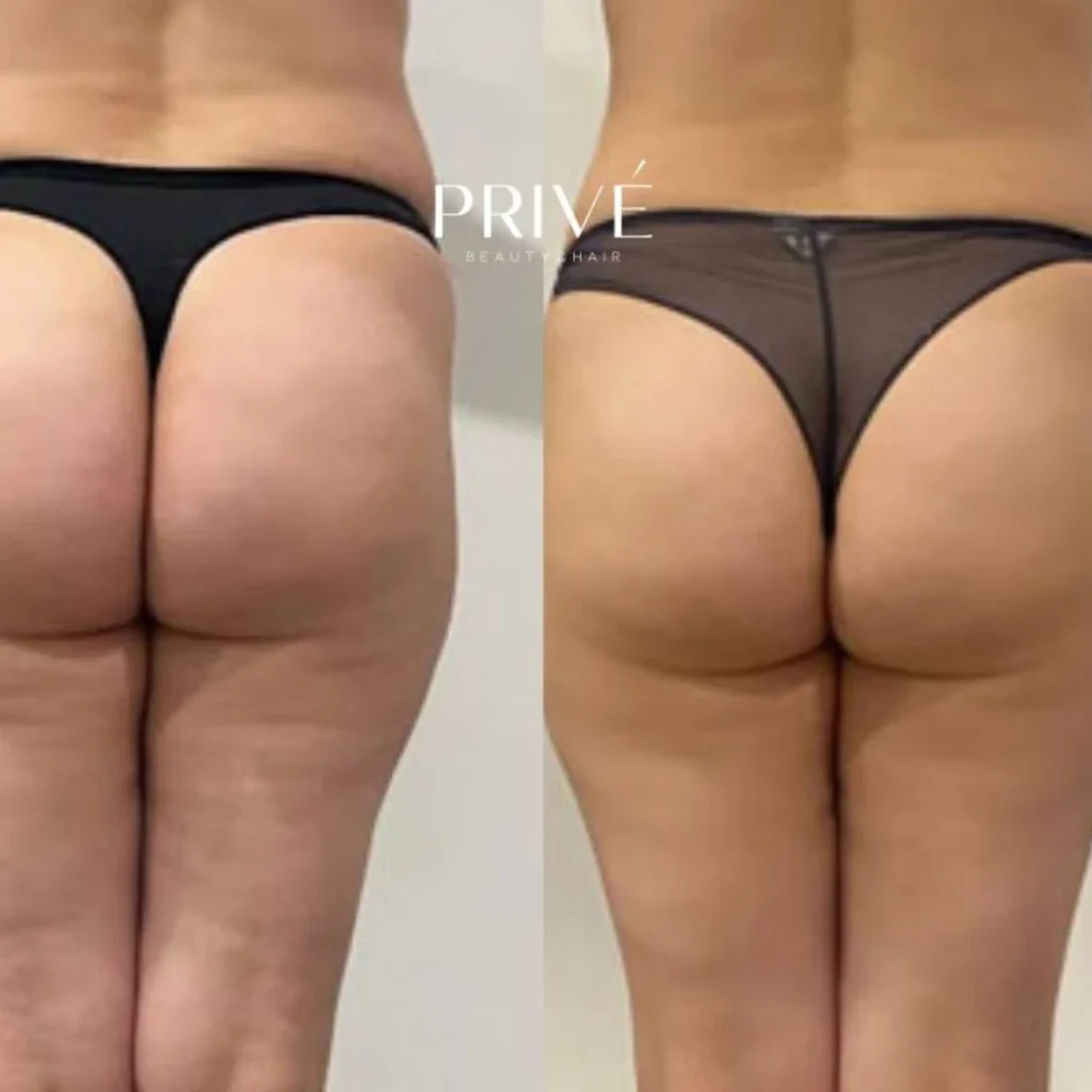 Modelowanie sylwetki – ujędrnienie pośladków przed i po w PRIVE Beauty & Hair Gdańsk