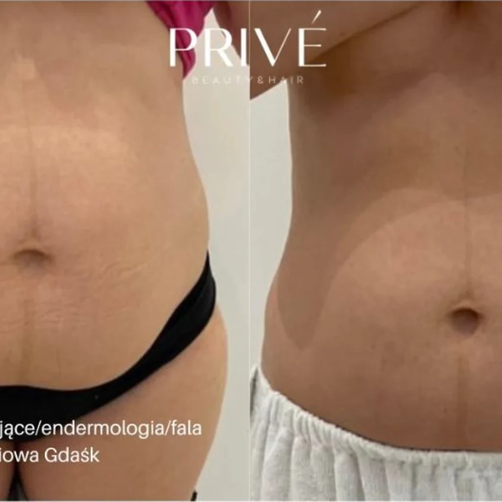 Modelowanie sylwetki – poprawa jędrności skóry przed i po w PRIVE Beauty & Hair Gdańsk