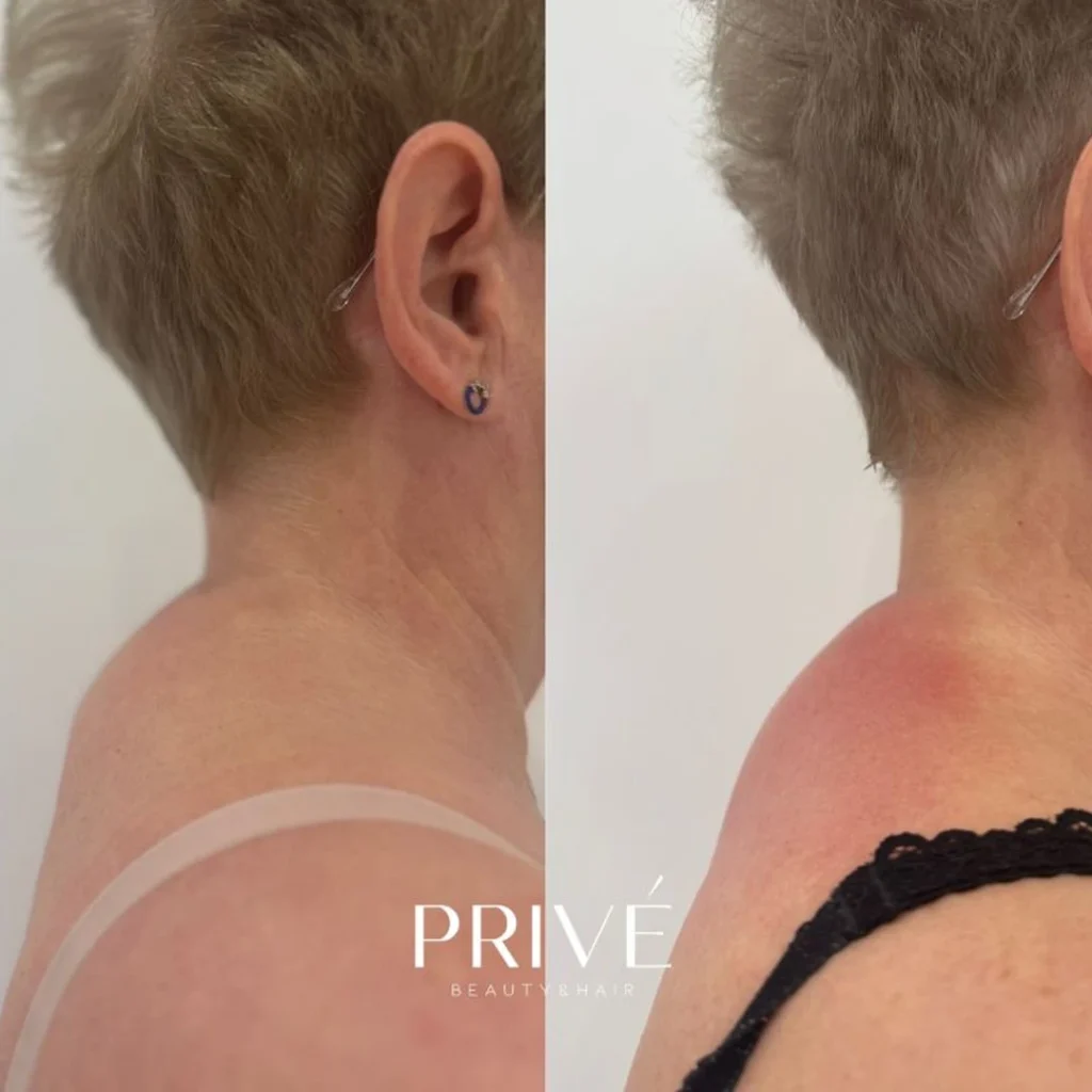 Modelowanie sylwetki – redukcja cellulitu na pośladkach przed i po w PRIVE Beauty & Hair Gdańsk
