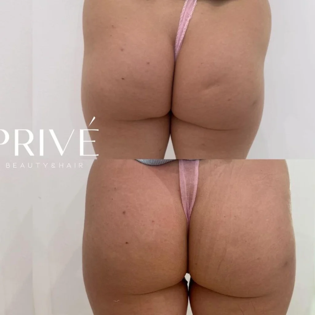Modelowanie sylwetki – ujędrnienie ud i pośladków przed i po w PRIVE Beauty & Hair Gdańsk