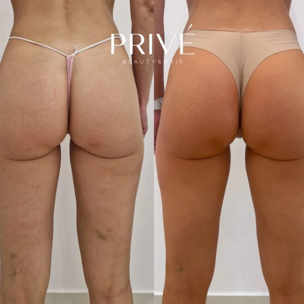 Modelowanie sylwetki – poprawa napięcia skóry przed i po w PRIVE Beauty & Hair Gdańsk