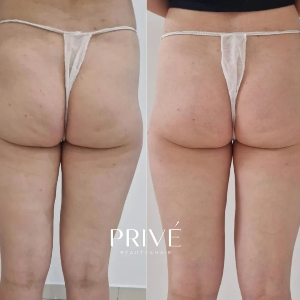 Modelowanie sylwetki – redukcja cellulitu przed i po w PRIVE Beauty & Hair Gdańsk