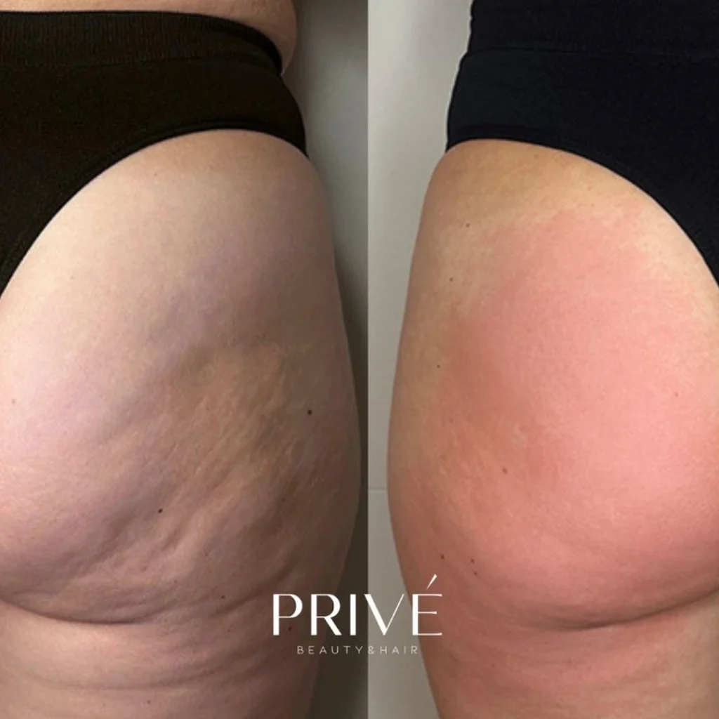 Modelowanie sylwetki – poprawa jędrności skóry przed i po w PRIVE Beauty & Hair Gdańsk
