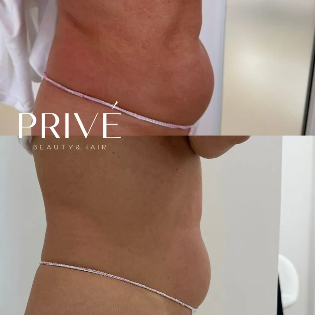 Modelowanie sylwetki – redukcja cellulitu na pośladkach przed i po w PRIVE Beauty & Hair Gdańsk