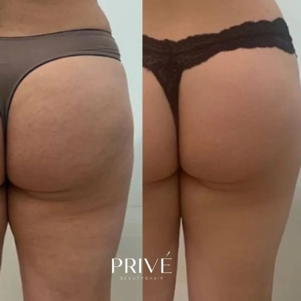 Modelowanie sylwetki – ujędrnienie ud i pośladków przed i po w PRIVE Beauty & Hair Gdańsk