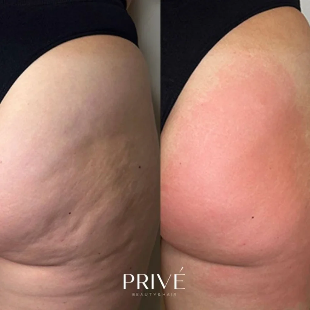 Modelowanie sylwetki – poprawa napięcia skóry przed i po w PRIVE Beauty & Hair Gdańsk