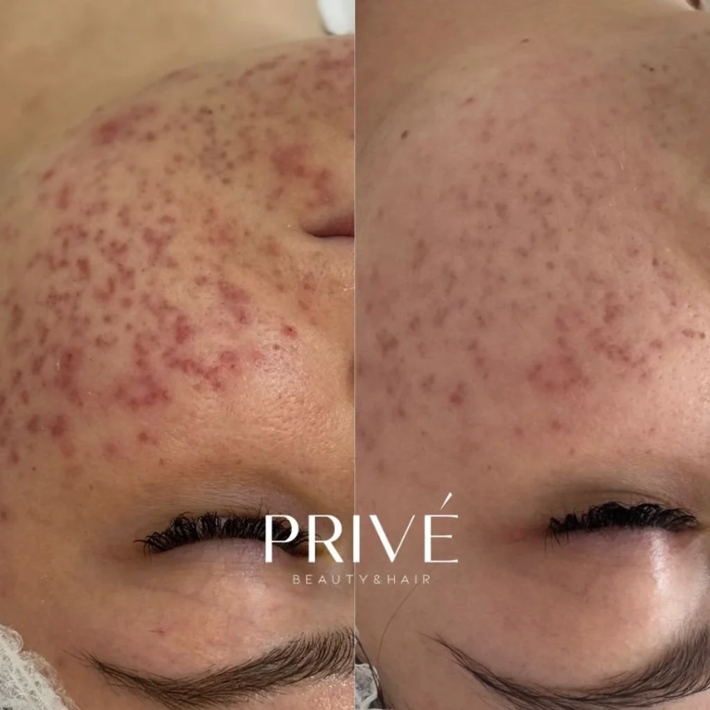 Peeling PCA Skin – redukcja zmian trądzikowych przed i po w PRIVE Gdańsk