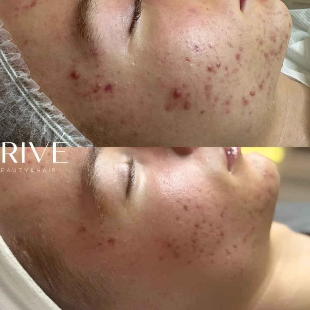 Peeling PCA Skin – trądzik różowaty przed i po zabiegu w PRIVE Gdańsk