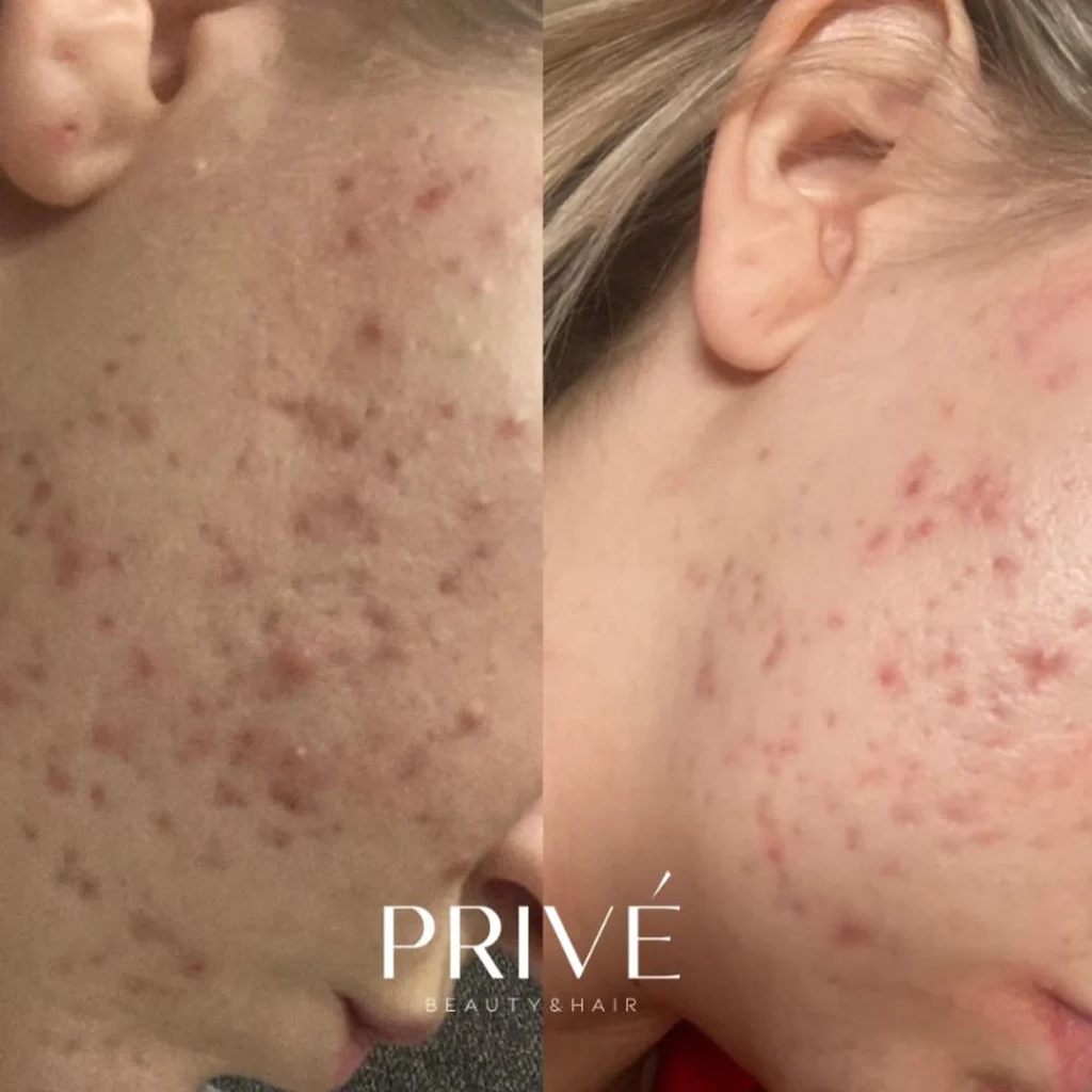 Peeling PCA Skin – wygładzenie i koloryt skóry przed i po w PRIVE Gdańsk