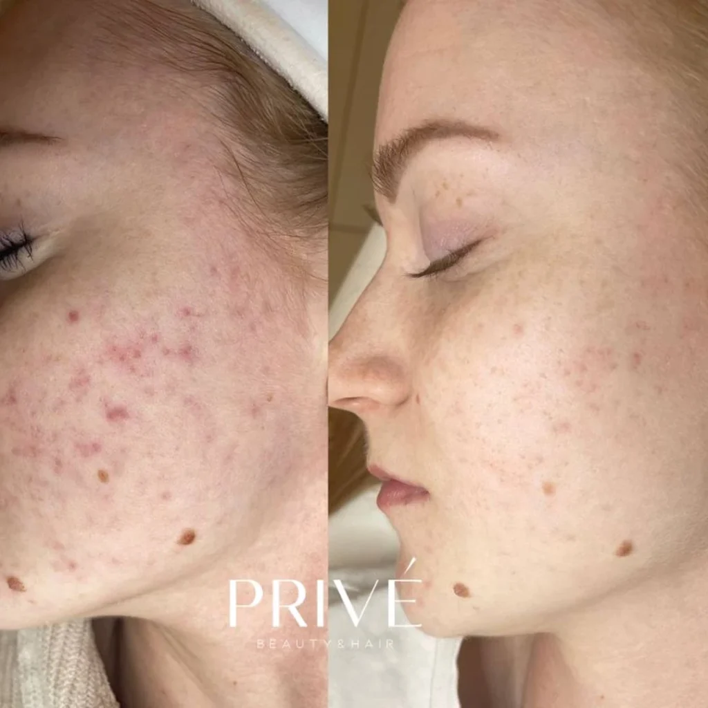 Peeling Jessnera – redukcja zmian trądzikowych przed i po w PRIVE Gdańsk