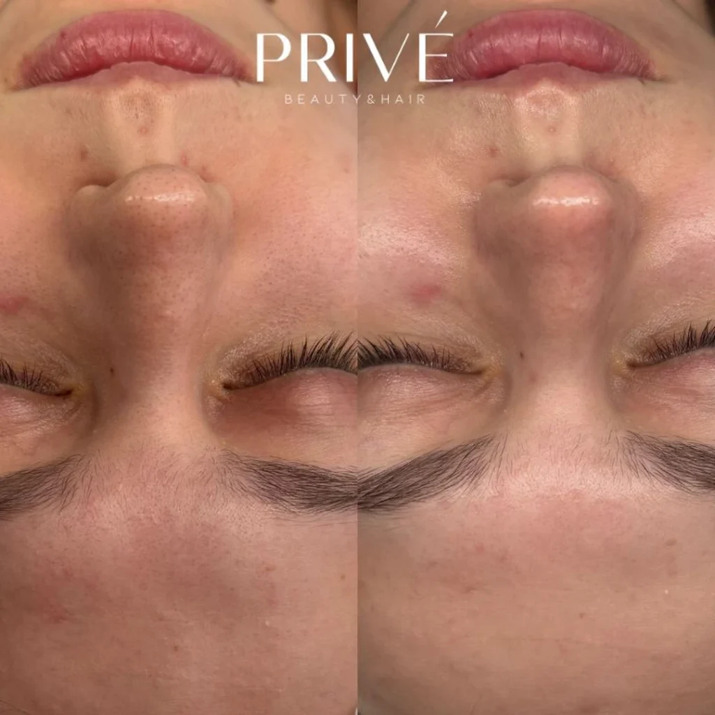 Peeling kawitacyjny – wygładzenie skóry czoła przed i po w PRIVE Gdańsk