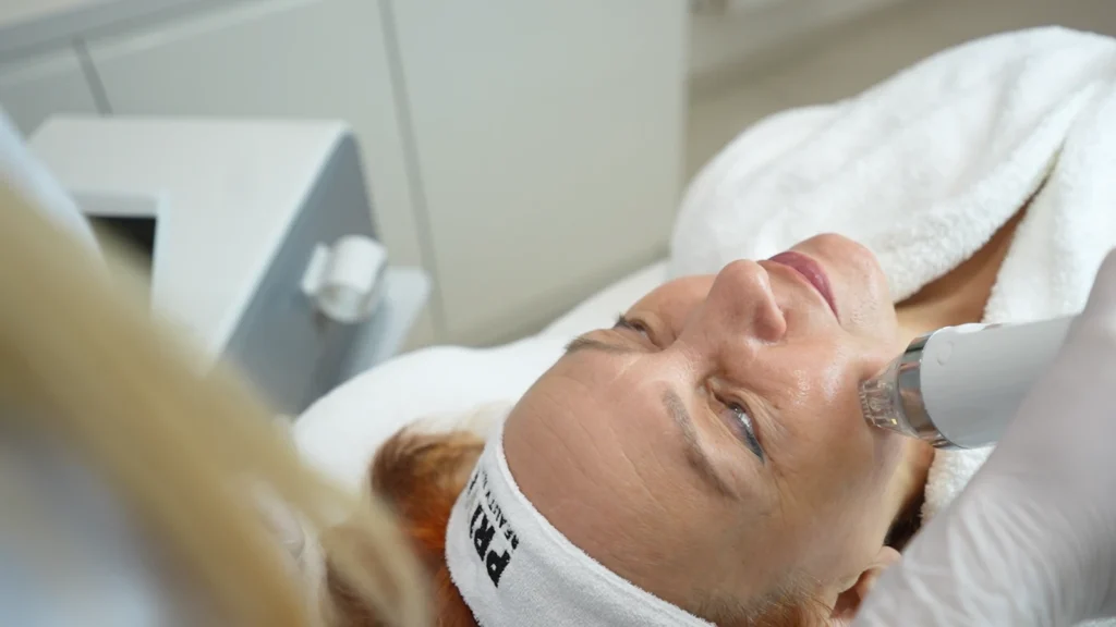 Zabieg radiofrekwencji mikroigłowej na twarzy w PRIVE Beauty & Hair w Gdańsku