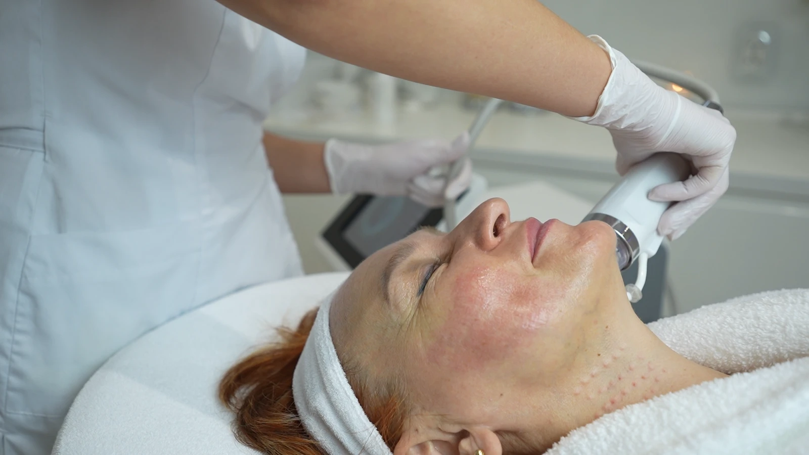 Głowica radiofrekwencji mikroigłowej na twarzy w gabinecie PRIVE Beauty & Hair Gdańsk