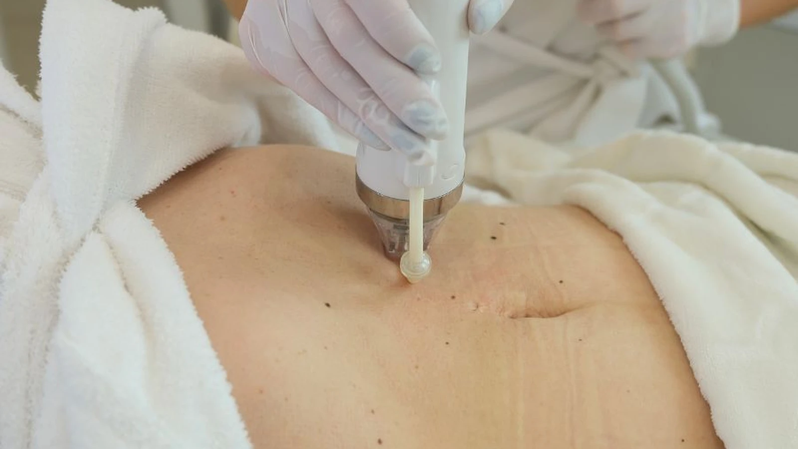 Radiofrekwencja mikroigłowa dekoltu w PRIVE Beauty & Hair w Gdańsku