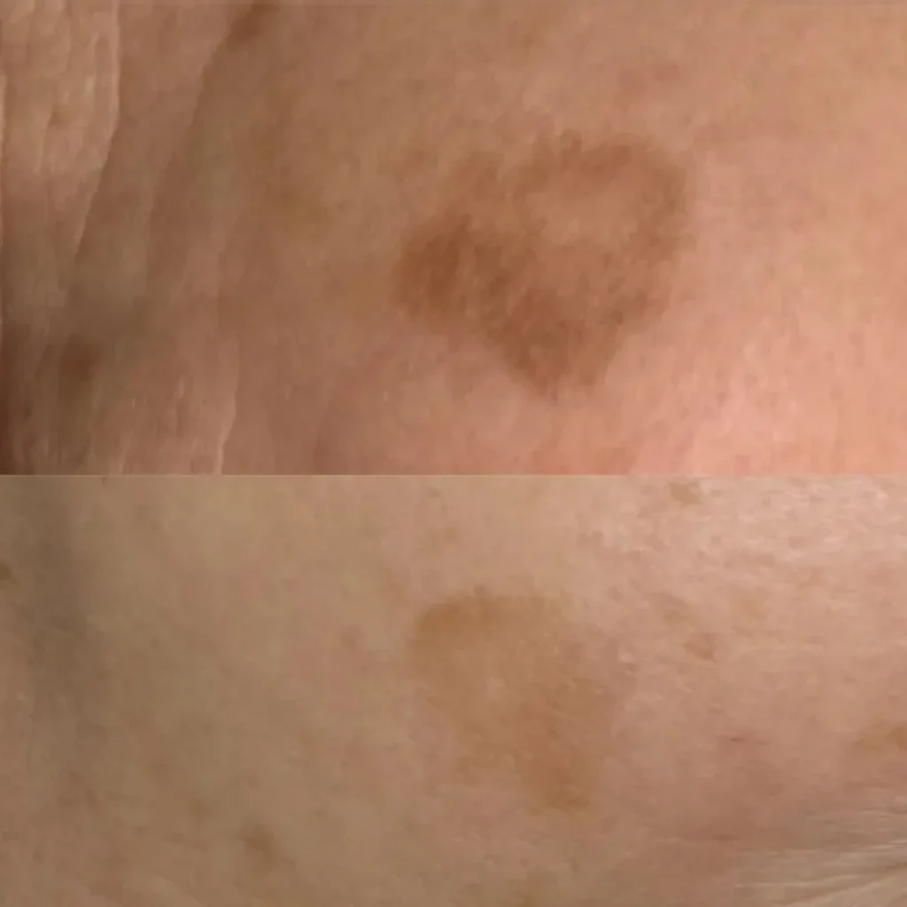Plama pigmentacyjna typu melasma na policzku — rozjaśnienie przed i po w PRIVE Gdańsk